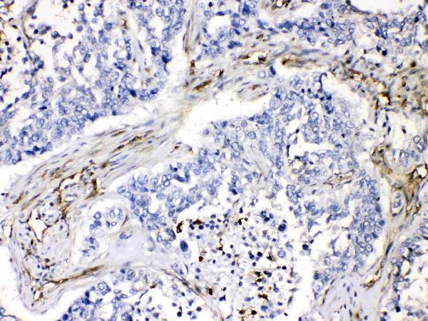 IHC analysis of VASP using anti-VASP antibody (A00303-1). VASP was detected in paraffin-embedded section of human lung cancer tissues. Heat mediated antigen retrieval was performed in citrate buffer (pH6, epitope retrieval solution) for 20 mins. The tissue section was blocked with 10% goat serum. The tissue section was then incubated with 1μg/ml rabbit anti-VASP Antibody (A00303-1) overnight at 4°C. Biotinylated goat anti-rabbit IgG was used as secondary antibody and incubated for 30 minutes at 37°C. The tissue section was developed using Strepavidin-Biotin-Complex (SABC)(Catalog # SA1022) with DAB as the chromogen.