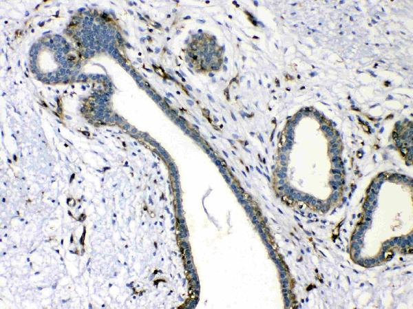 IHC analysis of VASP using anti-VASP antibody (A00303-1). VASP was detected in paraffin-embedded section of human mammary cancer tissues. Heat mediated antigen retrieval was performed in citrate buffer (pH6, epitope retrieval solution) for 20 mins. The tissue section was blocked with 10% goat serum. The tissue section was then incubated with 1μg/ml rabbit anti-VASP Antibody (A00303-1) overnight at 4°C. Biotinylated goat anti-rabbit IgG was used as secondary antibody and incubated for 30 minutes at 37°C. The tissue section was developed using Strepavidin-Biotin-Complex (SABC)(Catalog # SA1022) with DAB as the chromogen.