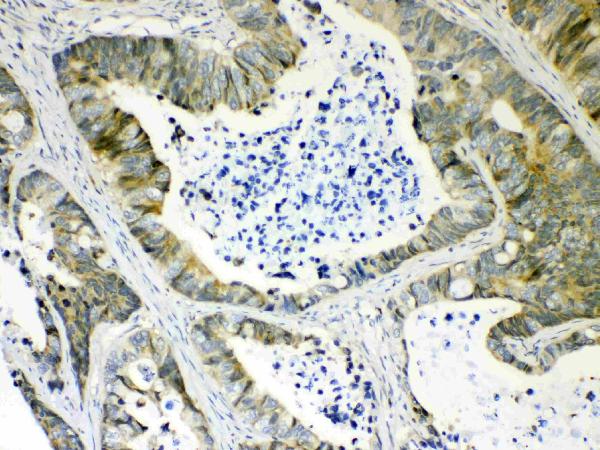 IHC analysis of AKR1B10 using anti-AKR1B10 antibody (A02976).