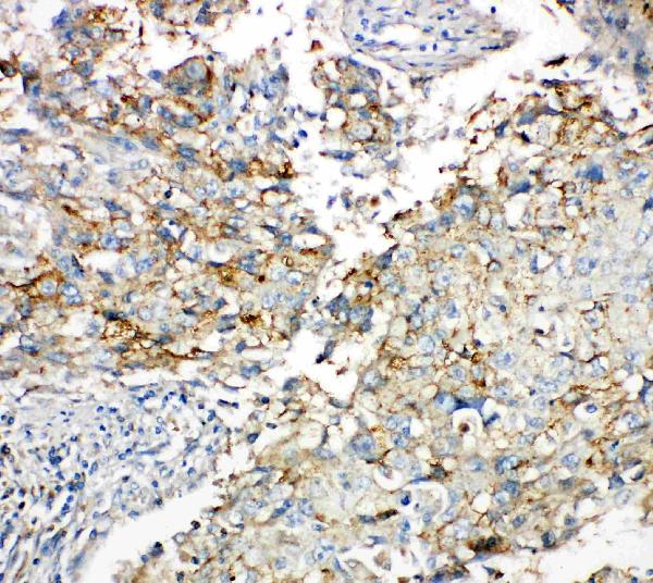 IHC analysis of Connexin 43/GJA1 using anti-Connexin 43/GJA1 antibody (PA1026-1). Connexin 43/GJA1 was detected in paraffin-embedded section of human lung cancer tissues. Heat mediated antigen retrieval was performed in citrate buffer (pH6, epitope retrieval solution) for 20 mins. The tissue section was blocked with 10% goat serum. The tissue section was then incubated with 1μg/ml rabbit anti-Connexin 43/GJA1 Antibody (PA1026-1) overnight at 4°C. Biotinylated goat anti-rabbit IgG was used as secondary antibody and incubated for 30 minutes at 37°C. The tissue section was developed using Strepavidin-Biotin-Complex (SABC)(Catalog # SA1022) with DAB as the chromogen.