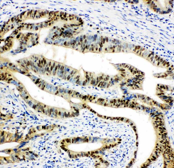 IHC analysis of DUT using anti-DUT antibody (PA1030-1). DUT was detected in paraffin-embedded section of human intestinal cancer tissues. Heat mediated antigen retrieval was performed in citrate buffer (pH6, epitope retrieval solution) for 20 mins. The tissue section was blocked with 10% goat serum. The tissue section was then incubated with 1μg/ml rabbit anti-DUT Antibody (PA1030-1) overnight at 4°C. Biotinylated goat anti-rabbit IgG was used as secondary antibody and incubated for 30 minutes at 37°C. The tissue section was developed using Strepavidin-Biotin-Complex (SABC)(Catalog # SA1022) with DAB as the chromogen.