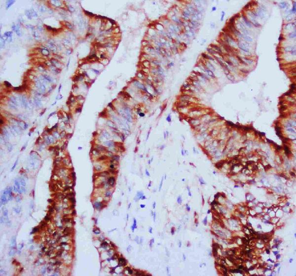 Anti-MAPK1/3 antibody, PA1049, IHC(P) IHC(P): Human Mammary Cancer Tissue