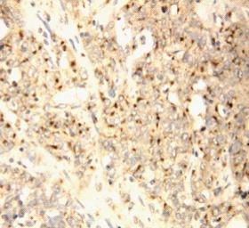 Anti-XAF1 antibody, PA1218, IHC(P) IHC(P): Human Endometrial Carcinoma Tissue