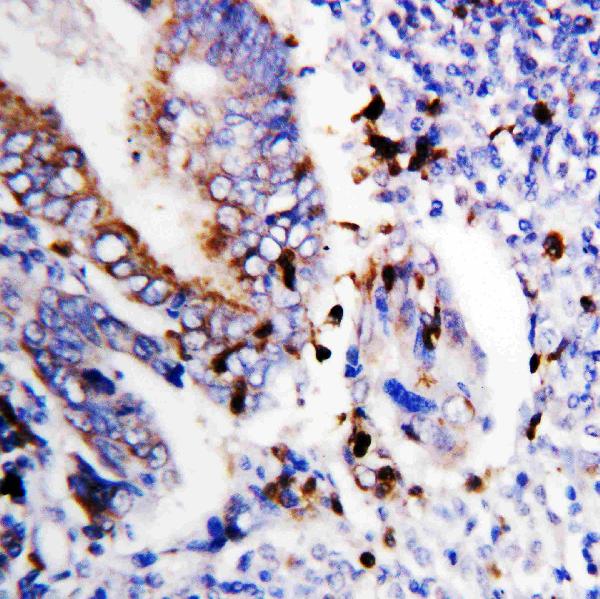 Anti-Bcl-XS antibody, PA1232, IHC(P) IHC(P): Human Colon Cancer Tissue