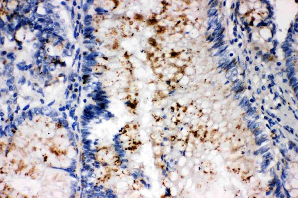 Anti-SSX2 antibody, PA1235, IHC(P) IHC(P): Human Intestinal Cancer Tissue