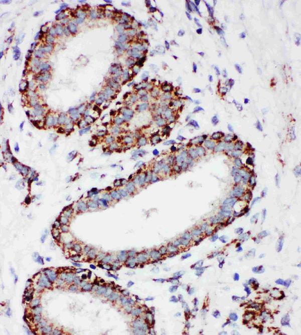 IHC analysis of MTCO1 using anti-MTCO1 antibody (PA1317-1). MTCO1 was detected in paraffin-embedded section of human mammary cancer tissues. Heat mediated antigen retrieval was performed in citrate buffer (pH6, epitope retrieval solution) for 20 mins. The tissue section was blocked with 10% goat serum. The tissue section was then incubated with 1μg/ml rabbit anti-MTCO1 Antibody (PA1317-1) overnight at 4°C. Biotinylated goat anti-rabbit IgG was used as secondary antibody and incubated for 30 minutes at 37°C. The tissue section was developed using Strepavidin-Biotin-Complex (SABC)(Catalog # SA1022) with DAB as the chromogen.