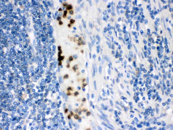 Cardiac FABP was detected in paraffin-embedded sections of human intestinal cancer tissues using rabbit anti-Cardiac FABP Antigen Affinity purified polyclonal antibody (Catalog # PA1336) at 1 μg/mL. The immunohistochemical section was developed using SABC method (Catalog # SA1022).