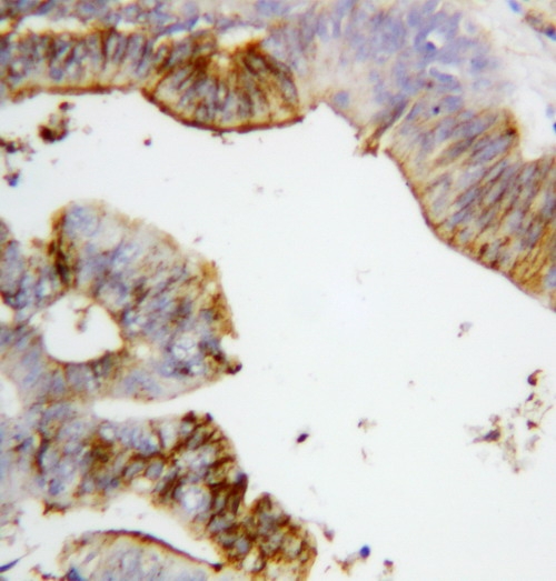 Anti-Annexin A2 antibody, PA1348, IHC(P) IHC(P): Human Intestinal Cancer Tissue