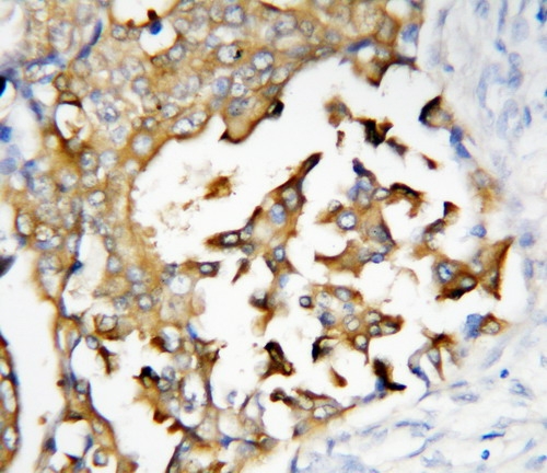 Anti-Presenilin 2 antibody, PA1358, IHC(P) IHC(P): Human Mammary Cancer Tissue