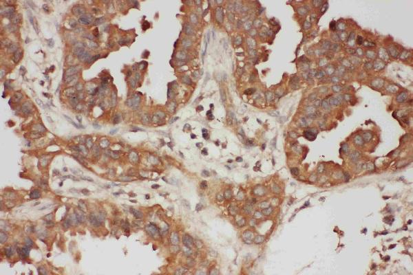 IHC analysis of Calpain 1 using anti-Calpain 1 antibody (PA1364). Calpain 1 was detected in paraffin-embedded section of human intestinal cancer tissues. Heat mediated antigen retrieval was performed in citrate buffer (pH6, epitope retrieval solution) for 20 mins. The tissue section was blocked with 10% goat serum. The tissue section was then incubated with 1μg/ml rabbit anti-Calpain 1 Antibody (PA1364) overnight at 4°C. Biotinylated goat anti-rabbit IgG was used as secondary antibody and incubated for 30 minutes at 37°C. The tissue section was developed using Strepavidin-Biotin-Complex (SABC)(Catalog # SA1022) with DAB as the chromogen.