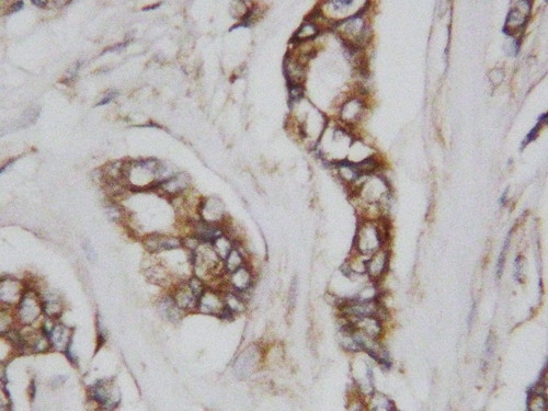 Anti-CDC42 antibody, PA1366, IHC(P) IHC(P): Human Mammary Cancer Tissue