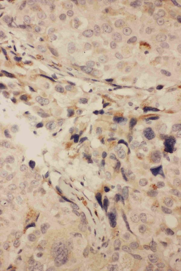 Anti-RANK antibody, PA1382, IHC(P) IHC(P): Human Mammary Cancer Tissue