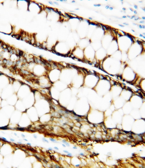 Anti-TIMP-1 antibody, PA1385, IHC(P) IHC(P): Human Mammary Cancer Tissue