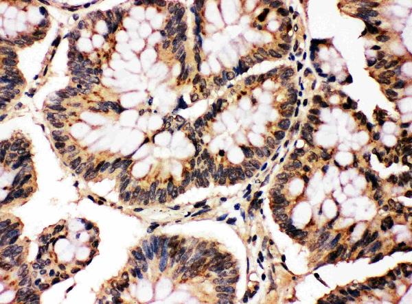 Anti-MAPK8/9 antibody, PA1407, IHC(P) IHC(P): Human Intestinal Cancer Tissue