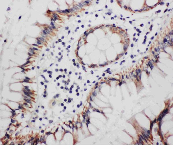 Anti-Progesterone Receptor antibody, PA1413, IHC(P) IHC(P): Human Rectal Cancer Tissue