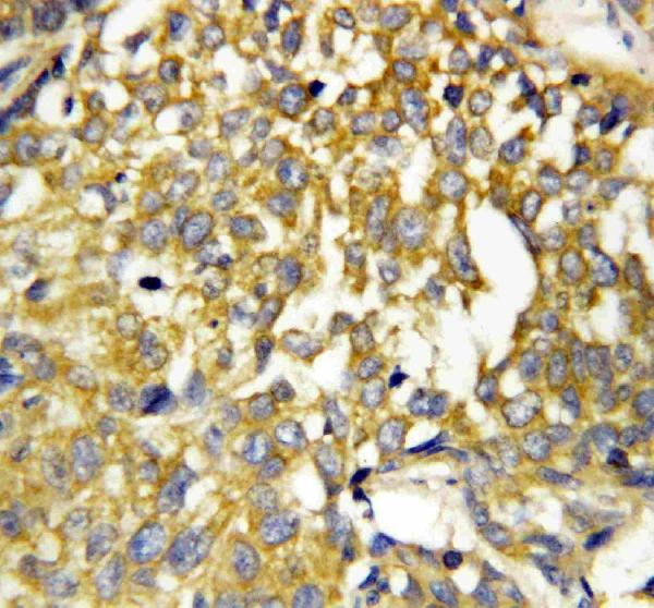 Anti-Pleiotrophin antibody, PA1414, IHC(P) IHC(P): Human Mammary Cancer Tissue