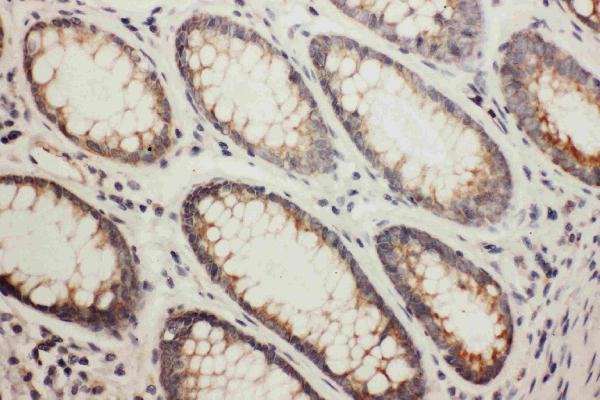 Anti-NDRG1 antibody, PA1416, IHC(P) IHC(P): Human Rectal Cancer Tissue