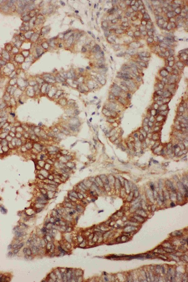 IHC analysis of BCL2L2 using anti-BCL2L2 antibody (PA1426-1). BCL2L2 was detected in paraffin-embedded section of human rectal cancer tissues. Heat mediated antigen retrieval was performed in citrate buffer (pH6, epitope retrieval solution) for 20 mins. The tissue section was blocked with 10% goat serum. The tissue section was then incubated with 1μg/ml rabbit anti-BCL2L2 Antibody (PA1426-1) overnight at 4°C. Biotinylated goat anti-rabbit IgG was used as secondary antibody and incubated for 30 minutes at 37°C. The tissue section was developed using Strepavidin-Biotin-Complex (SABC)(Catalog # SA1022) with DAB as the chromogen.