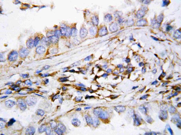 Anti-CXCL9 antibody, PA1429, IHC(P) IHC(P): Human Lung Cancer Tissue