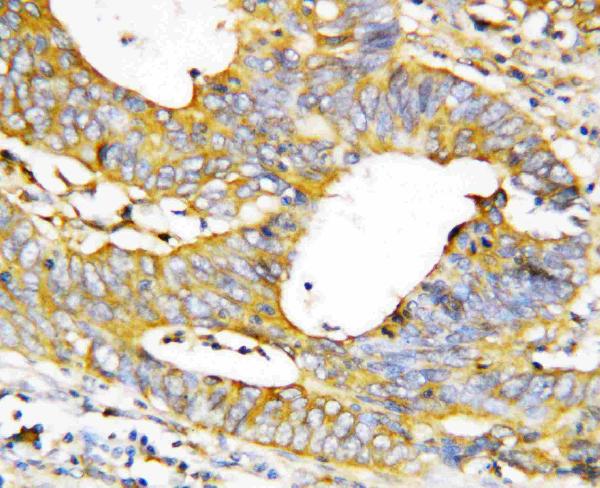 Anti-Caspase-1(P20) antibody, PA1440, IHC(P) IHC(P): Human Mammary Cancer Tissue