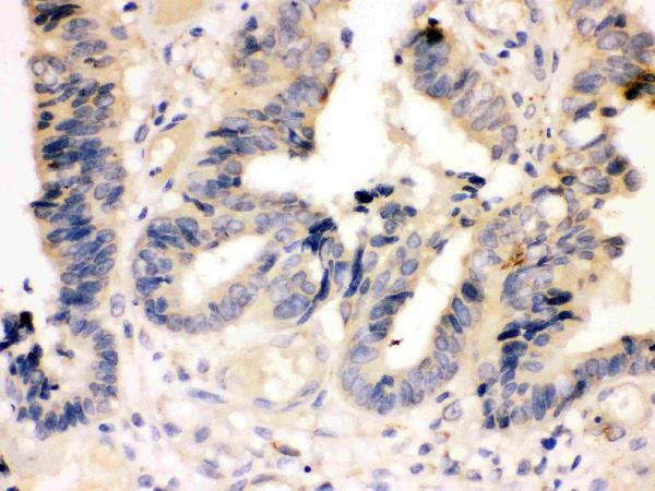 Anti-Caspase-7(P11) antibody, PA1442, IHC(P) IHC(P): Human Intestinal Cancer Tissue