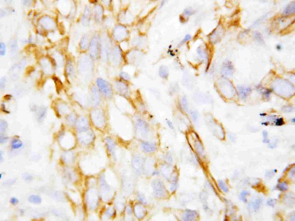 Anti-beta Defensin 1 antibody, PA1450, IHC(P) IHC(P): Lung Cancer Tissue