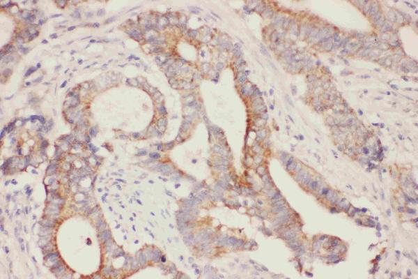 Anti-Fatty Acid Binding Protein 5 antibody, PA1475, IHC(P) IHC(P): Human Intestinal Cancer Tissue