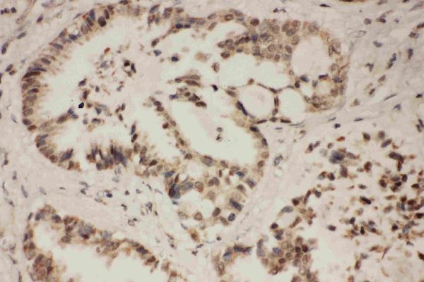Anti-FGFR1 antibody, PA1477, IHC(P) IHC(P): Human Lung Cancer Tissue