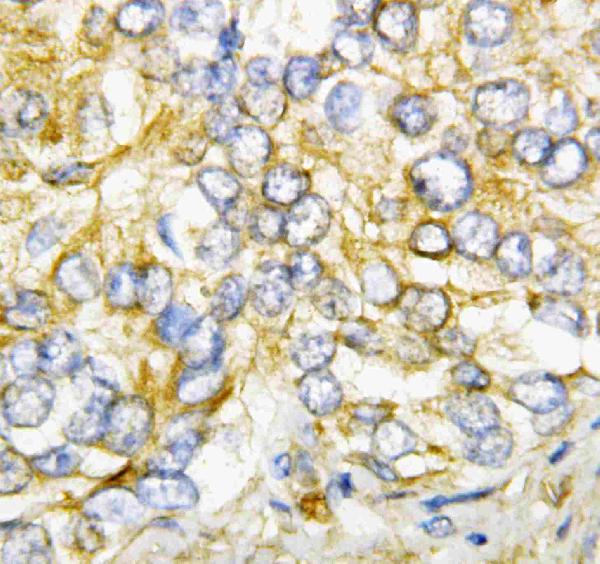 IHC analysis of AIMP2 using anti-AIMP2 antibody (PA1481). AIMP2 was detected in paraffin-embedded section of human rectal cancer tissues. Heat mediated antigen retrieval was performed in citrate buffer (pH6, epitope retrieval solution) for 20 mins. The tissue section was blocked with 10% goat serum. The tissue section was then incubated with 1μg/ml rabbit anti-AIMP2 Antibody (PA1481) overnight at 4°C. Biotinylated goat anti-rabbit IgG was used as secondary antibody and incubated for 30 minutes at 37°C. The tissue section was developed using Strepavidin-Biotin-Complex (SABC)(Catalog # SA1022) with DAB as the chromogen.