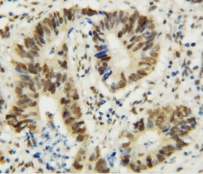 Anti-MTA1 antibody, PA1483, IHC(P) IHC(P): Human Rectal Cancer Tissue