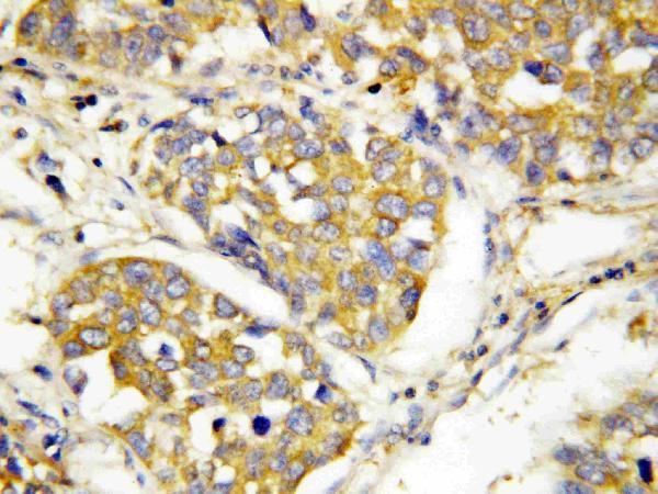 Anti-TLR4 antibody, PA1484, IHC(P) IHC(P): Human Lung Cancer Tissue