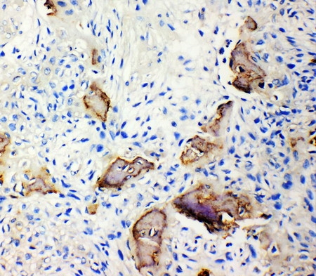 Anti-Bone Sialoprotein antibody, PA1505, IHC(P) IHC(P): Human Osteosarcoma Tissue