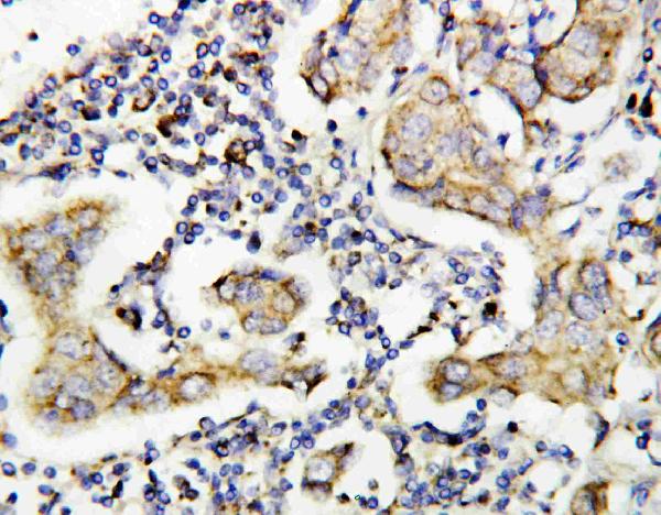 Anti-Caspase-8(P10) antibody, PA1524, IHC(P) IHC(P): Human Mammary Cancer Tissue