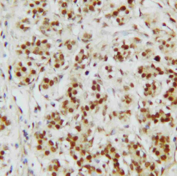 IHC analysis of CTBP2 using anti-CTBP2 antibody (PA1554). CTBP2 was detected in paraffin-embedded section of human mammary cancer tissues. Heat mediated antigen retrieval was performed in citrate buffer (pH6, epitope retrieval solution) for 20 mins. The tissue section was blocked with 10% goat serum. The tissue section was then incubated with 1μg/ml rabbit anti-CTBP2 Antibody (PA1554) overnight at 4°C. Biotinylated goat anti-rabbit IgG was used as secondary antibody and incubated for 30 minutes at 37°C. The tissue section was developed using Strepavidin-Biotin-Complex (SABC)(Catalog # SA1022) with DAB as the chromogen.