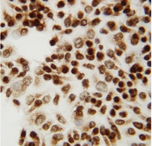 IHC analysis of CTBP2 using anti-CTBP2 antibody (PA1554). CTBP2 was detected in immunocytochemical section of human HeLa cell. Enzyme antigen retrieval was performed using IHC enzyme antigen retrieval reagent (AR0022) for 15 mins. The cells were blocked with 10% goat serum. And then incubated with 1μg/ml rabbit anti-CTBP2 Antibody (PA1554) overnight at 4°C. Biotinylated goat anti-rabbit IgG was used as secondary antibody and incubated for 30 minutes at 37°C. The section was developed using Strepavidin-Biotin-Complex (SABC)(Catalog # SA1022) with DAB as the chromogen.