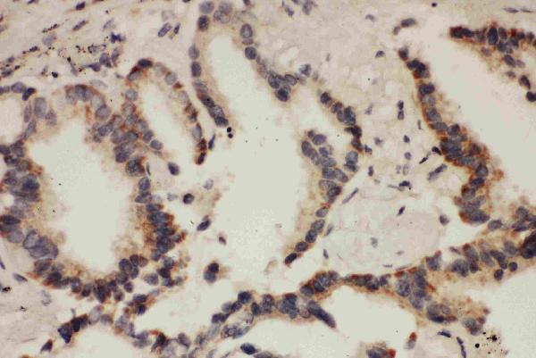 Anti-Cullin 1 antibody, PA1557, IHC(P) IHC(P): Human Lung Cancer Tissue