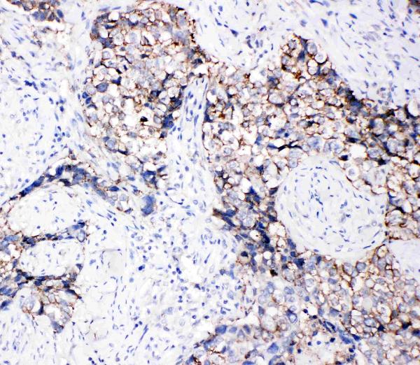 Anti-Eph receptor B3 antibody, PA1569, IHC(P) IHC(P): Human Lung Cancer Tissue