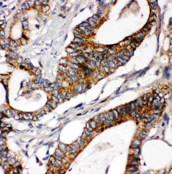 Anti-Laminin gamma 1 antibody, PA1581, IHC(P) IHC(P): Human Intestinal Cancer Tissue