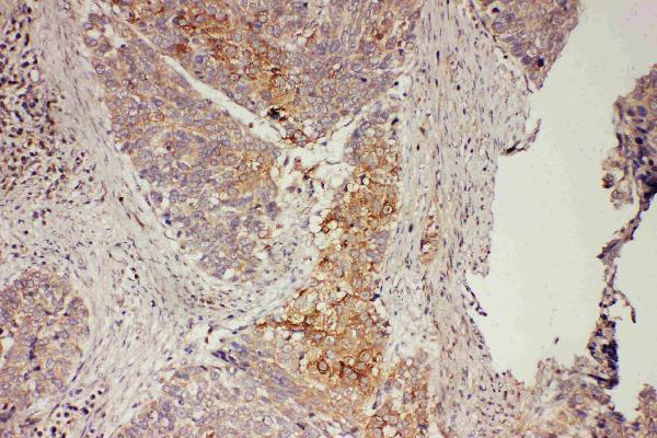 Anti-GRB7 antibody, PA1589-1, IHC(P) IHC(P): Human Oesophagus Squama Cancer Tissue