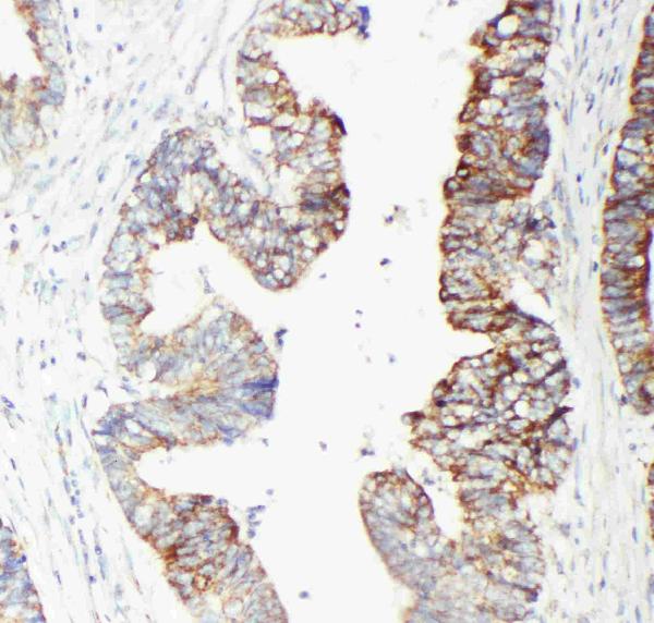 Anti-GST3/GST pi antibody, PA1590, IHC(P) IHC(P): Human Intestinal Cancer Tissue