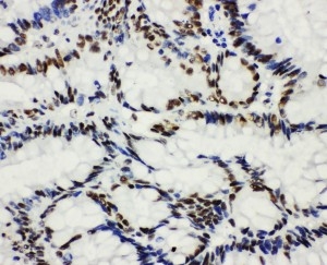 IHC analysis of HDAC3 using anti-HDAC3 antibody (PA1600-1). HDAC3 was detected in paraffin-embedded section of human intestinal cancer tissues. Heat mediated antigen retrieval was performed in citrate buffer (pH6, epitope retrieval solution) for 20 mins. The tissue section was blocked with 10% goat serum. The tissue section was then incubated with 1μg/ml rabbit anti-HDAC3 Antibody (PA1600-1) overnight at 4°C. Biotinylated goat anti-rabbit IgG was used as secondary antibody and incubated for 30 minutes at 37°C. The tissue section was developed using Strepavidin-Biotin-Complex (SABC)(Catalog # SA1022) with DAB as the chromogen.