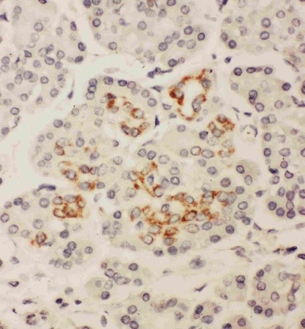 Anti-HOXA3 antibody, PA1602, IHC(P) IHC(P): Human Pancreatic Cancer Tissue