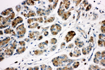 Anti-Kallikrein 1 antibody, PA1625, IHC(P) IHC(P): Human Pancreatic Cancer Tissue