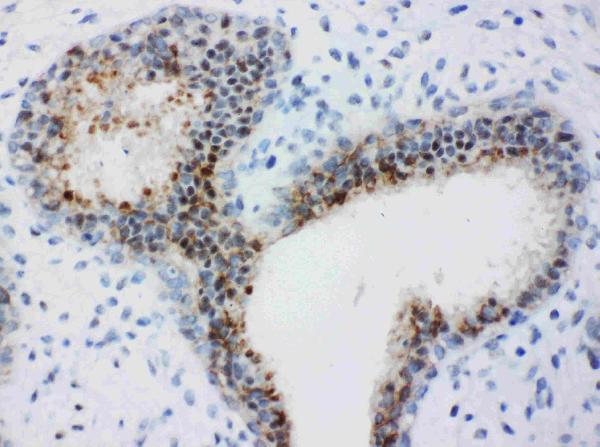 Anti-Bub3 antibody, PA1645, IHC(P) IHC(P): Human Mammary Cancer Tissue