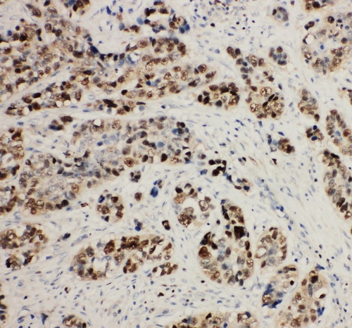 Anti-MCM2 antibody, PA1650, IHC(P) IHC(P): Human Lung Cancer Tissue