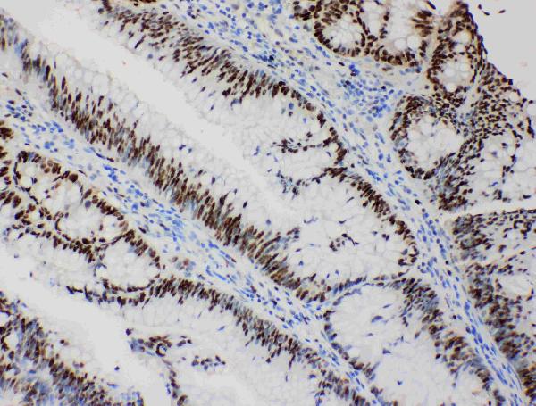 Anti-MCM2 antibody, PA1650, IHC(P) IHC(P): Human Intestinal Cancer Tissue