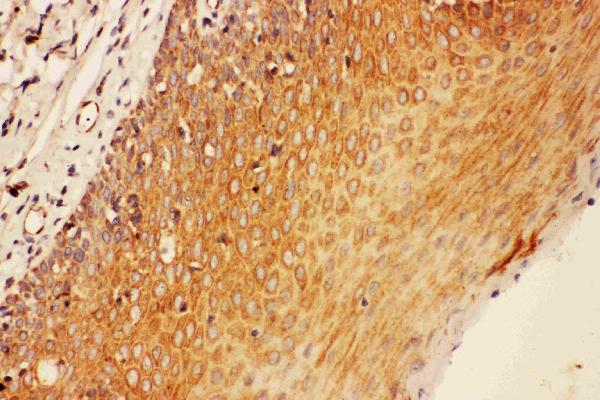 IHC analysis of SOCS3 using anti-SOCS3 antibody (PA1707). SOCS3 was detected in paraffin-embedded section of human tonsil tissues. Heat mediated antigen retrieval was performed in citrate buffer (pH6, epitope retrieval solution) for 20 mins. The tissue section was blocked with 10% goat serum. The tissue section was then incubated with 1μg/ml rabbit anti-SOCS3 Antibody (PA1707) overnight at 4°C. Biotinylated goat anti-rabbit IgG was used as secondary antibody and incubated for 30 minutes at 37°C. The tissue section was developed using Strepavidin-Biotin-Complex (SABC)(Catalog # SA1022) with DAB as the chromogen.