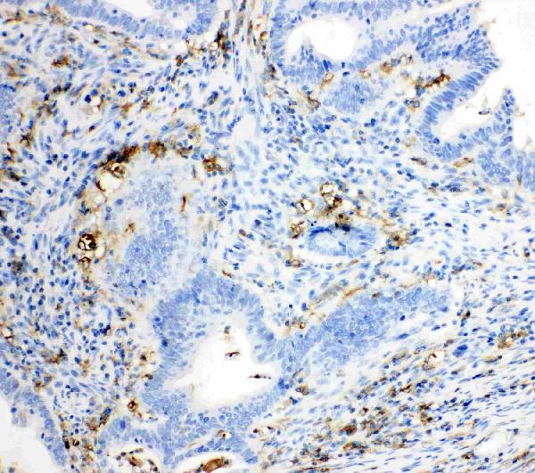 IHC analysis of TRPC6 using anti-TRPC6 antibody (PA1754). TRPC6 was detected in paraffin-embedded section of human intestinal cancer tissues. Heat mediated antigen retrieval was performed in citrate buffer (pH6, epitope retrieval solution) for 20 mins. The tissue section was blocked with 10% goat serum. The tissue section was then incubated with 1μg/ml rabbit anti-TRPC6 Antibody (PA1754) overnight at 4°C. Biotinylated goat anti-rabbit IgG was used as secondary antibody and incubated for 30 minutes at 37°C. The tissue section was developed using Strepavidin-Biotin-Complex (SABC)(Catalog # SA1022) with DAB as the chromogen.