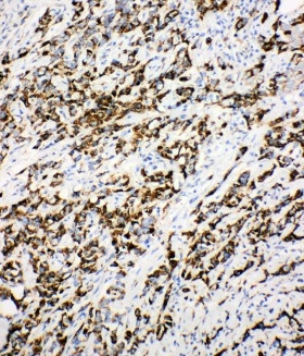 IHC analysis of DCI using anti-DCI antibody (PA1763). DCI was detected in paraffin-embedded section of human mammary cancer tissues. Heat mediated antigen retrieval was performed in citrate buffer (pH6, epitope retrieval solution) for 20 mins. The tissue section was blocked with 10% goat serum. The tissue section was then incubated with 1μg/ml rabbit anti-DCI Antibody (PA1763) overnight at 4°C. Biotinylated goat anti-rabbit IgG was used as secondary antibody and incubated for 30 minutes at 37°C. The tissue section was developed using Strepavidin-Biotin-Complex (SABC)(Catalog # SA1022) with DAB as the chromogen.