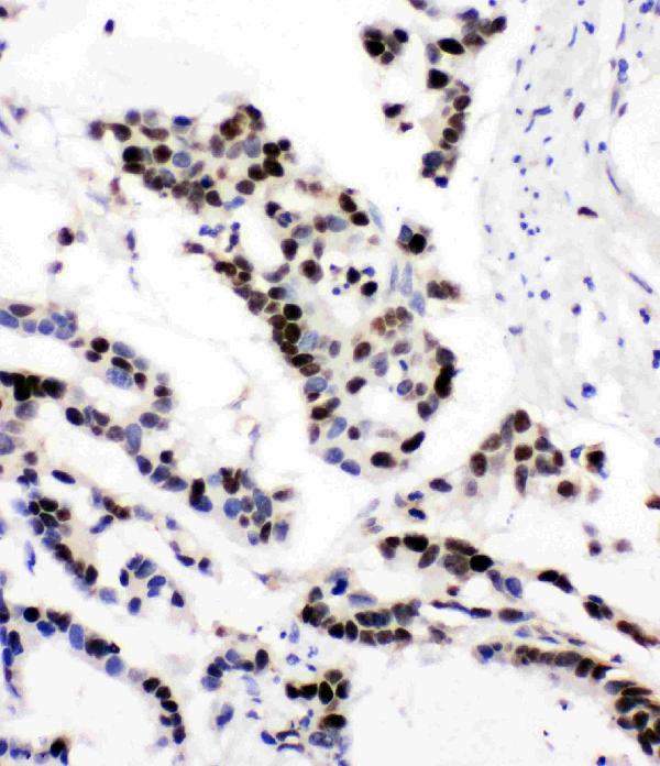 Anti-MCM6 antibody, PA1769, IHC(P) IHC(P): Human Intestinal Cancer Tissue